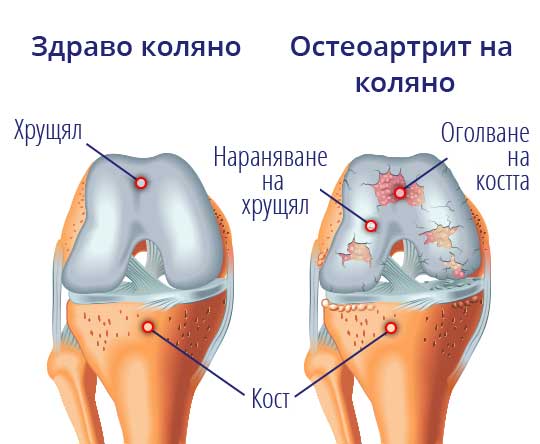 Anatomic picture of the knee shows the causes of arthritis_joint pain